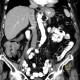 Carcinoma of ascending colon, colorectal carcinoma: CT - Computed tomography